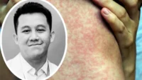 Dokter-muda-meninggal-karena-campak-391906034