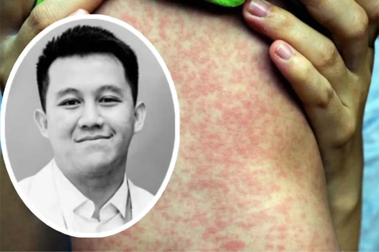 Penjelasan Kemenkes soal Kematian Dokter di Cianjur: Diagnosis Akhir Campak dengan Gangguan Jantung-Otak